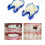 Temporary Denture Braces Occlude Upper Dentures Veneer Dentures Missing Teeth Broken Teeth 1