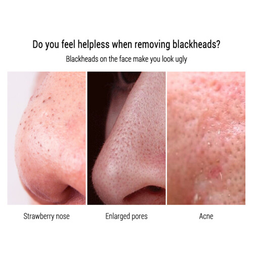 LANBENA Blackhead Remover Cream with 60 Pore Strips 2