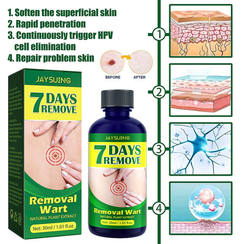 (1PCS) 1/2pcs Removal Wart Liquid Warts Treatment Remove Skin Tags 1