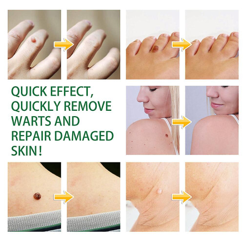 (2PCS) 1/2pcs Removal Wart Liquid Warts Treatment Remove Skin Tags 2