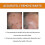 (2pcs) Bee Venom For Warts And Papillomas 3