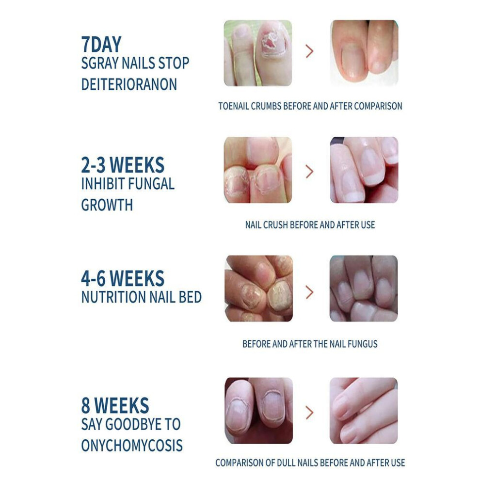 (15ml) Repair Nail Fungus Treatments Essence Foot Care Serum Toe Nails Fungal Removal Gel Anti-Infection
