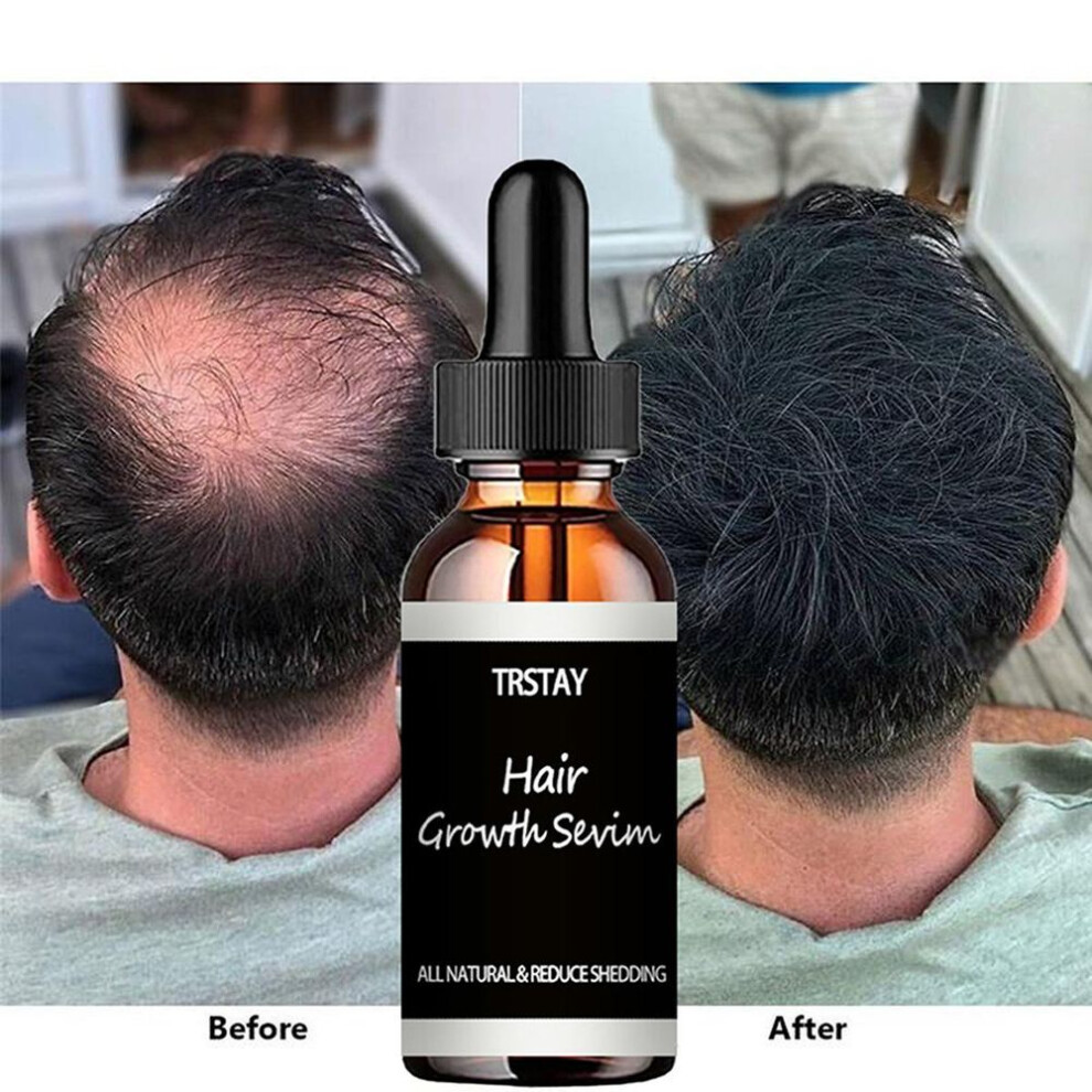 (50ml) Hair Regrowth For Women,minoxidil-5% Extra Strength Hair Regrowth For Men