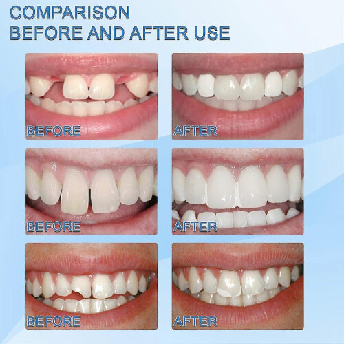 30ml Moldable False Teeth White Particles Reusable Non-toxic Temporarily Fill Regain Smile 2