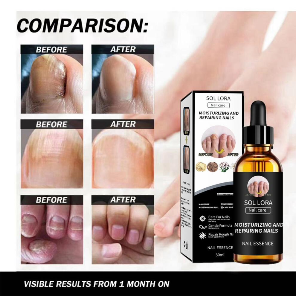 Yetp Star Onychomycosis Liquid Brightening Nail Moisturizing Nails And Nail Nutrition Care Solution