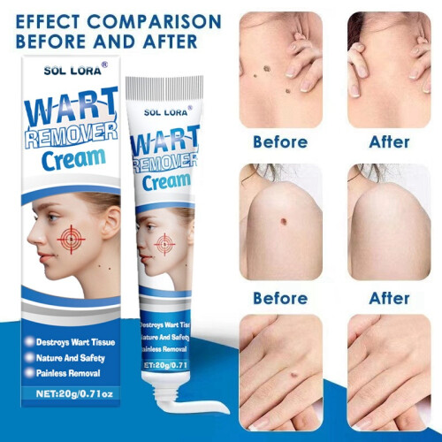 Wart Removal Cream Wart Flat Corn Cream Flat Wart Wart Moxa Cream 2