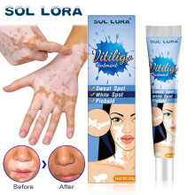 Spot Care Health Cream White Spot Cleansing Ointment Spot Sweat Spot Vitiligo Vitiligo Skin External Cream