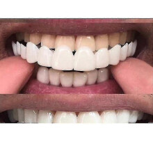 (The Baby Tooth Under, One size) New Snap On Smile Dental False Teeth Cover Perfect Smile Veneers Comfort Fit Flex Denture Teeth