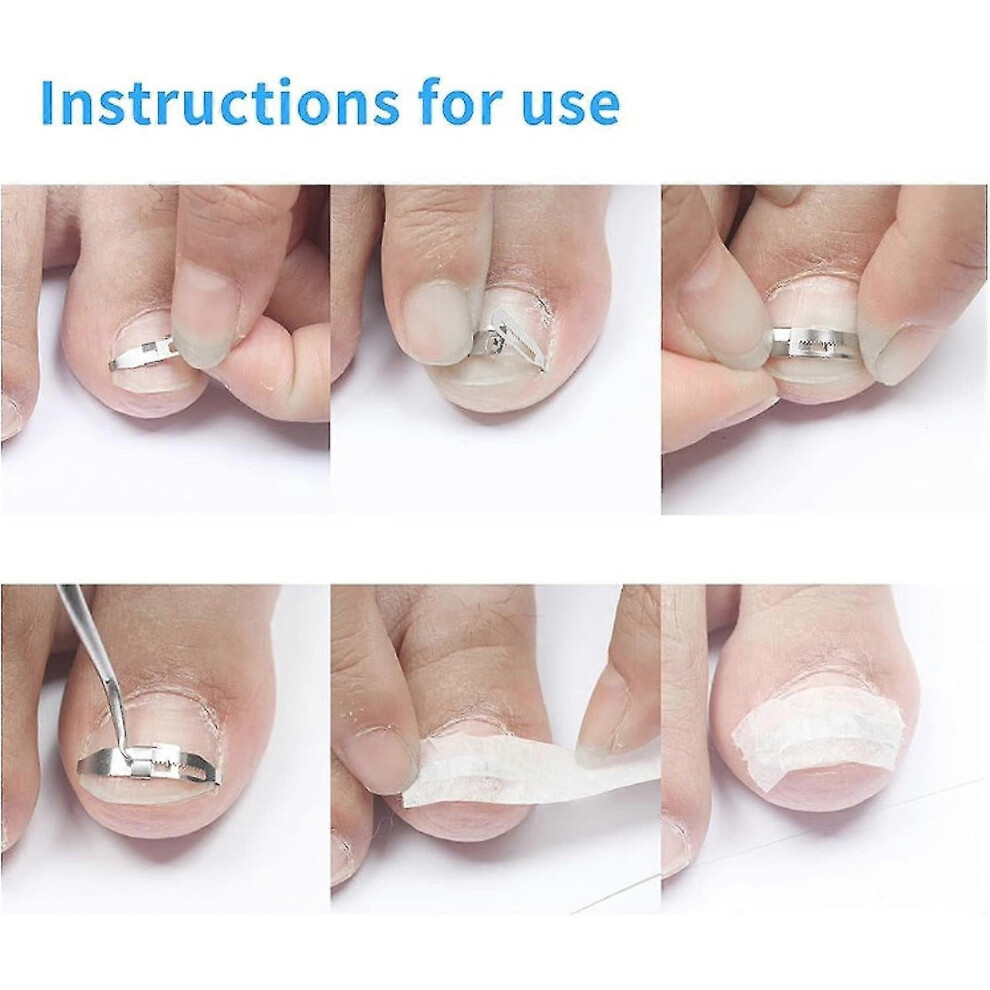 Stainless steel ingrown toenail corrector, toenail and fingernail care tool, treatment for paronychia