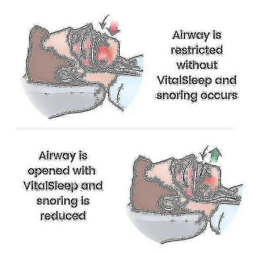 Adjustable Mouth with Silicone Anti-snoring Device 2