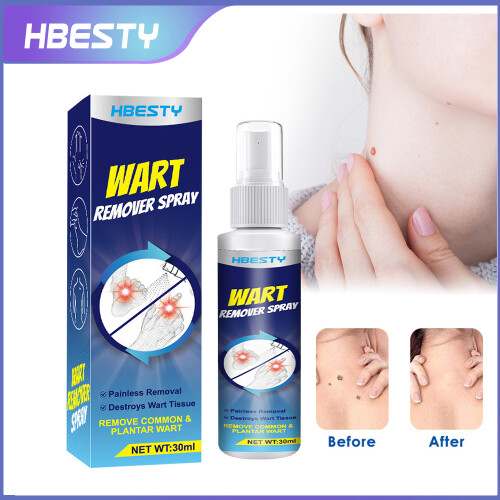 Wart Removal Spray Wart Pest Care Solution Cock Eye Grain Care Solution