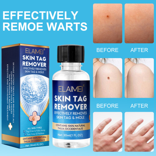 Wart Removal Solution Bottles, Wart Removal, Wart Removal, Corns, Meat Thorns, Flat Warts, Sharp Silk 1