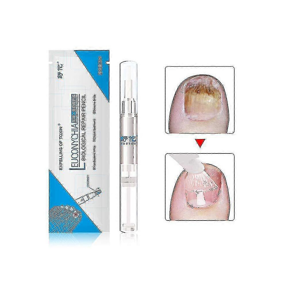 Exsader Not,Specified (As Show, One Size) 3Ml Fungal Treatment Nail Polish Pen Antifungal Nail Cutin Remover