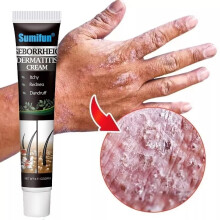 New 20g Seborrheic Psoriasis Cream Remove Dandruff Head Pruritus Scalp Natural