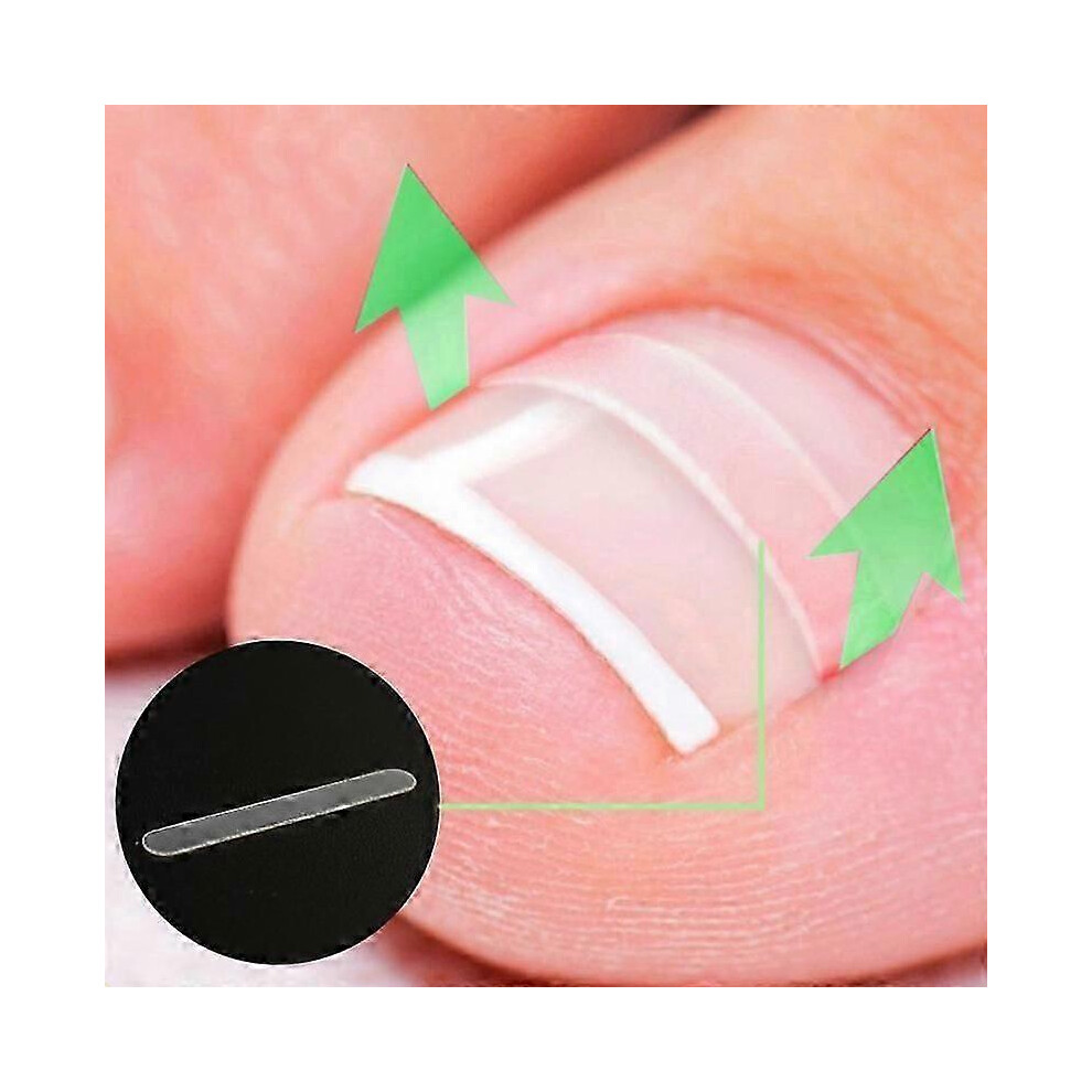 10pcs Ingrown Nail Pad Toenail Correction Tool Ingrown Toe Nail Treatments Elastic