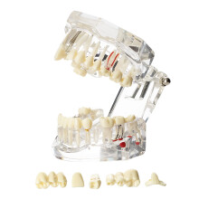 Dentalmall Tandheelkundig Oraal Typodont-model Implantaat Pathologisch Verwijderbaar Lesdemonstratie Zichtbare anatomiedemonstratie Lesgeven Standaar