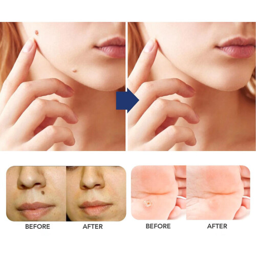 Skin Tag Remover Haut Tag Remover Serum von 1