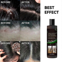 Anti-itch Shampoo for Tinea Capitis To Dandruff And Relieve Itchy Scalp