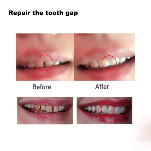 Tooth Filling Thermal Beads Do it Yourself Moldable False Teeth for Temporary Teeth Repair The Missing and Broken Tooth Replacement Kit(2 Pack) 2