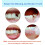 Tooth Filling Thermal Beads Do it Yourself Moldable False Teeth for Temporary Teeth Repair The Missing and Broken Tooth Replacement Kit(2 Pack) 4