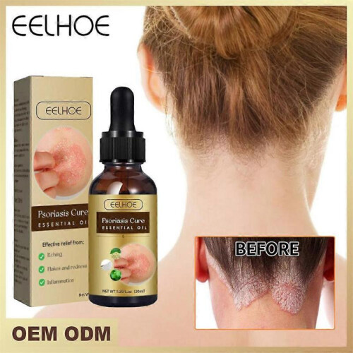 3x Huile Essentielle Psoriasis 1