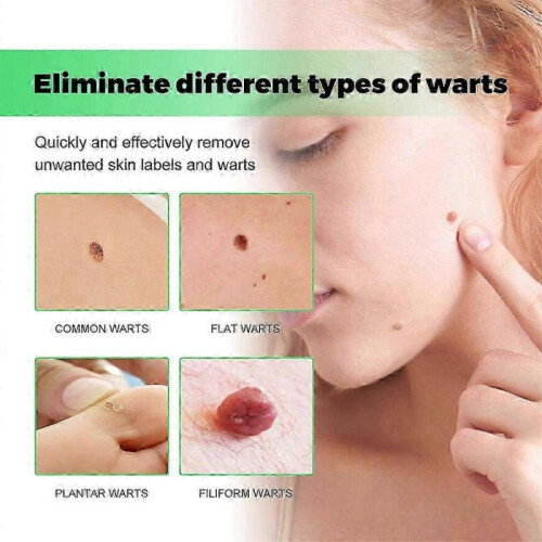 Skin Wart Eliminator Soaps, Wart Removal Soap,Instant Blemish 1