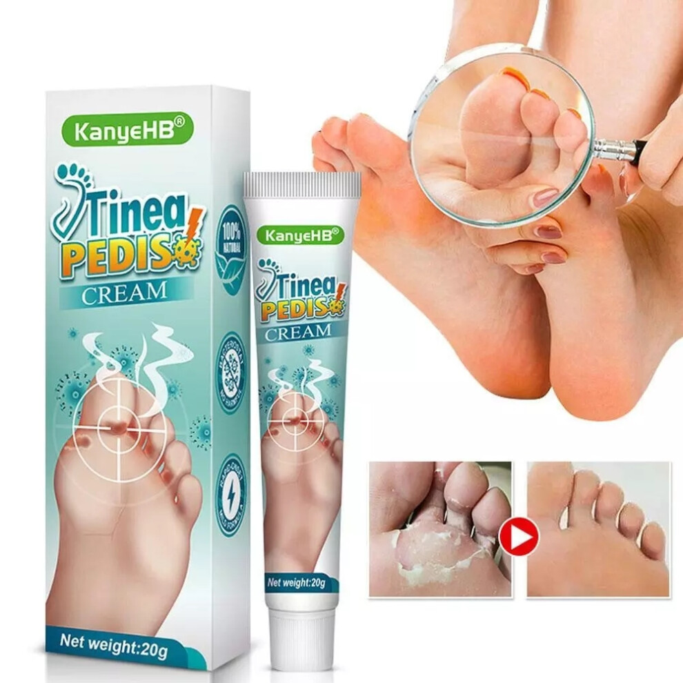 Yetp Star Treat Athlete's Feet Ointment Foot Itching Anti-Fungal Peeling Tinea