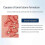 Electronic Tonsil Stone Remover Vacuum, Tonsil Stone Removal Kit, Instant Suction Tonsil Stone Remo 2