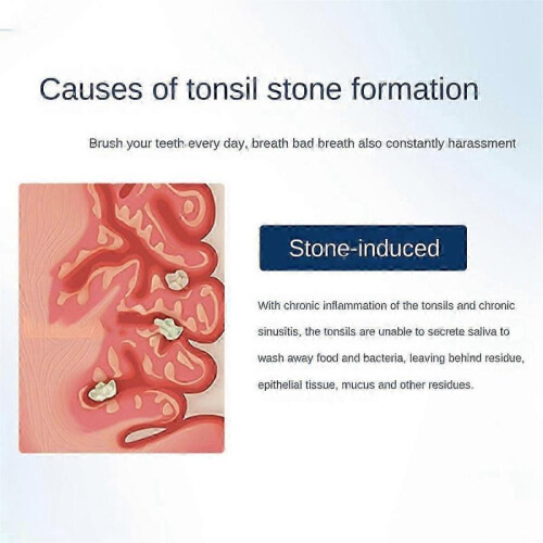 Electronic Tonsil Stone Remover Vacuum, Tonsil Stone Removal Kit, Instant Suction Tonsil Stone Remo 1