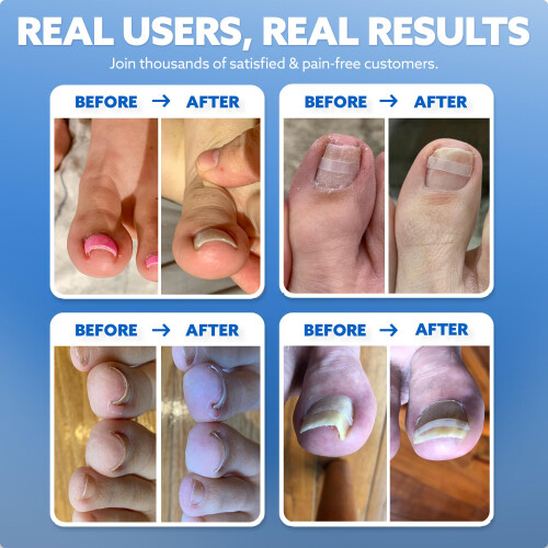 CurveCorrect Ingrown Toenail Home Treatment 2