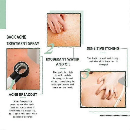 Jaysuing Back Smallpox Diluting Back Shoulder Clean And Smooth Skin 120ml 2