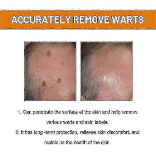 Bee Venom for Warts And Papillomas 2