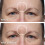 Dermaflage Scar Filler Refill  4 Applicators 4