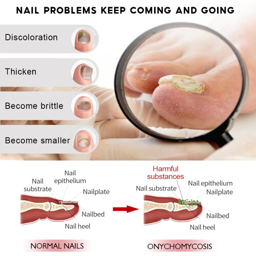 Ginger Nail Care Solution Hand And Foot Grey Nail Cleansing Treatment Solution 1