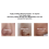 Visual Blackhead Remover Deep Clean Machine Blackheads 6