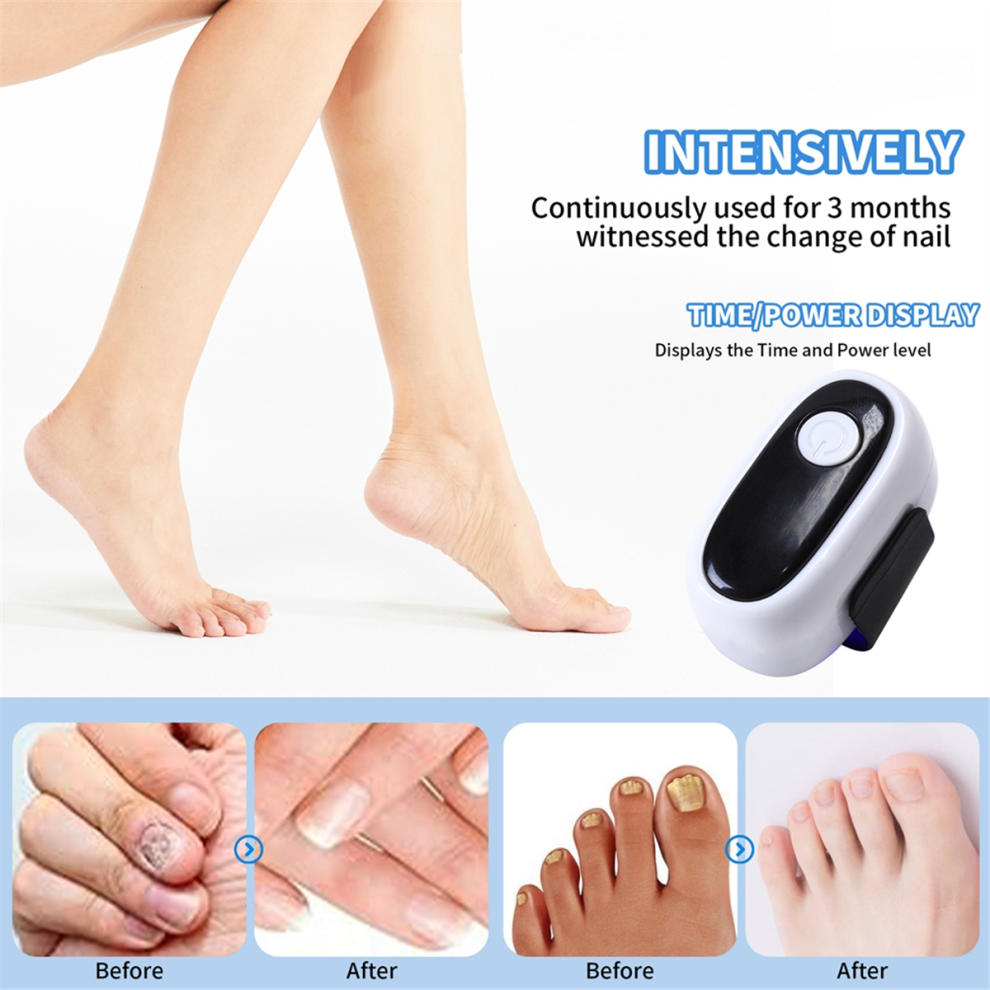 Sin Marca Nail Laser Treatment Device For Treat A