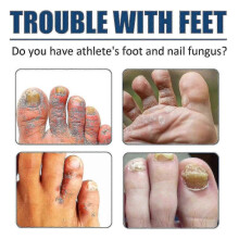 South Moon foot spray relieves sweaty, itchy, peeling, onychomycosis and foot odor, moisturizing and refreshing care