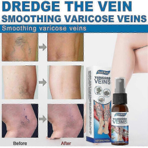 (4pcs)Varicose Vein Massage Spray for South Moon 2