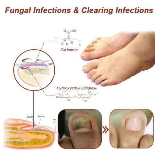 South Moon Nail Fungus Light Therapy Device 2