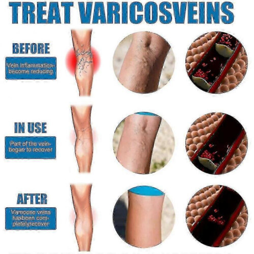 (3pcs)Varicose Vein Massage Spray for South Moon 1