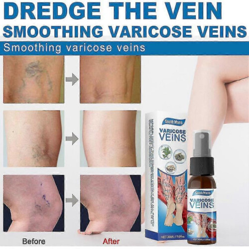 (3pcs)Varicose Vein Massage Spray for South Moon 2