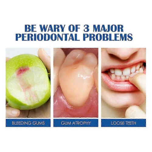 (1pcs) SOUTH MOON Gingival Fixation Toothpaste Curing Teeth Soothing Gingival Pain 2
