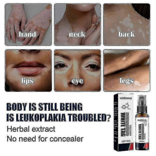 South Moon Vitiligo Treatment Spray 1