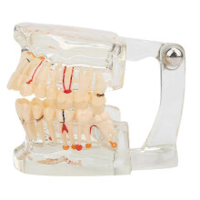 (As show, One size) Transparent Disease Teeth Model Dental Implant Teeth Model Hospital Study Teaching Instruments