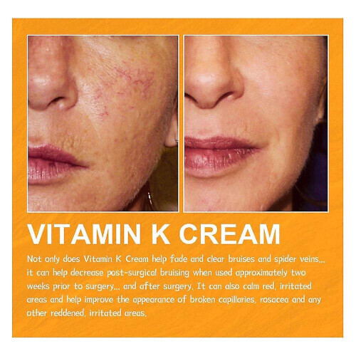 2pcs Vitamin K Cream For Bruising s - s Soothe 1