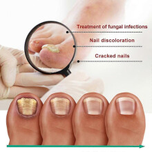 (1-2) 30ml X3 Toenail Repair Liquid Soft Nail Repair Liquid Cleaning