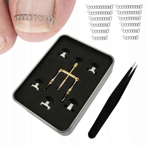 Buckle for Ingrown Nails 1