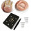 Buckle for Ingrown Nails 4
