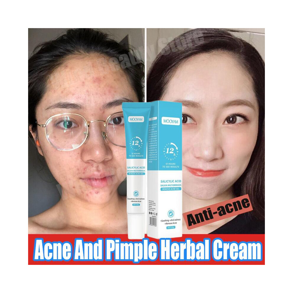 (Buy 2 get 1 free)Acne Cream For Face Pimples Remover Treatment Shrink Pores Oil Control Lighten Acne Marks Whitening Smoothing Facial Skin Care