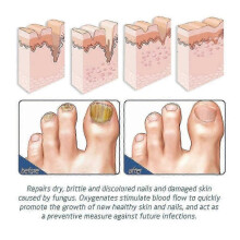 (3PCS) 1-10xOnycostop Pro Foot and Nail Spary Foot Odor Treatment Spray Nail Growth Ser